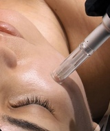 Book an Appointment with Microneedling Exosomes + PDRN at La clinique Versa MD situé à Montréal